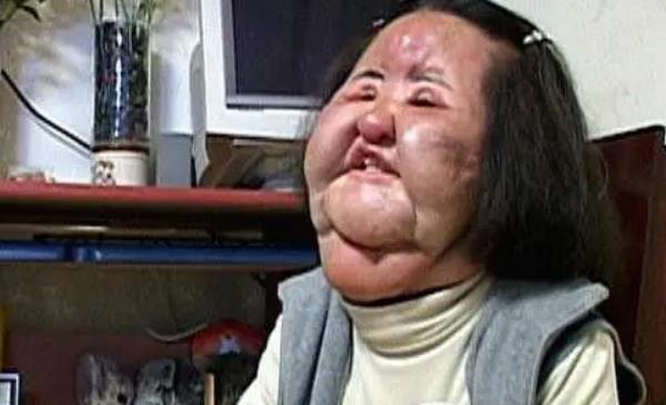 王一博|女星韩慧景:为了更漂亮,给脸注射食用油,把脸整成“猪头”