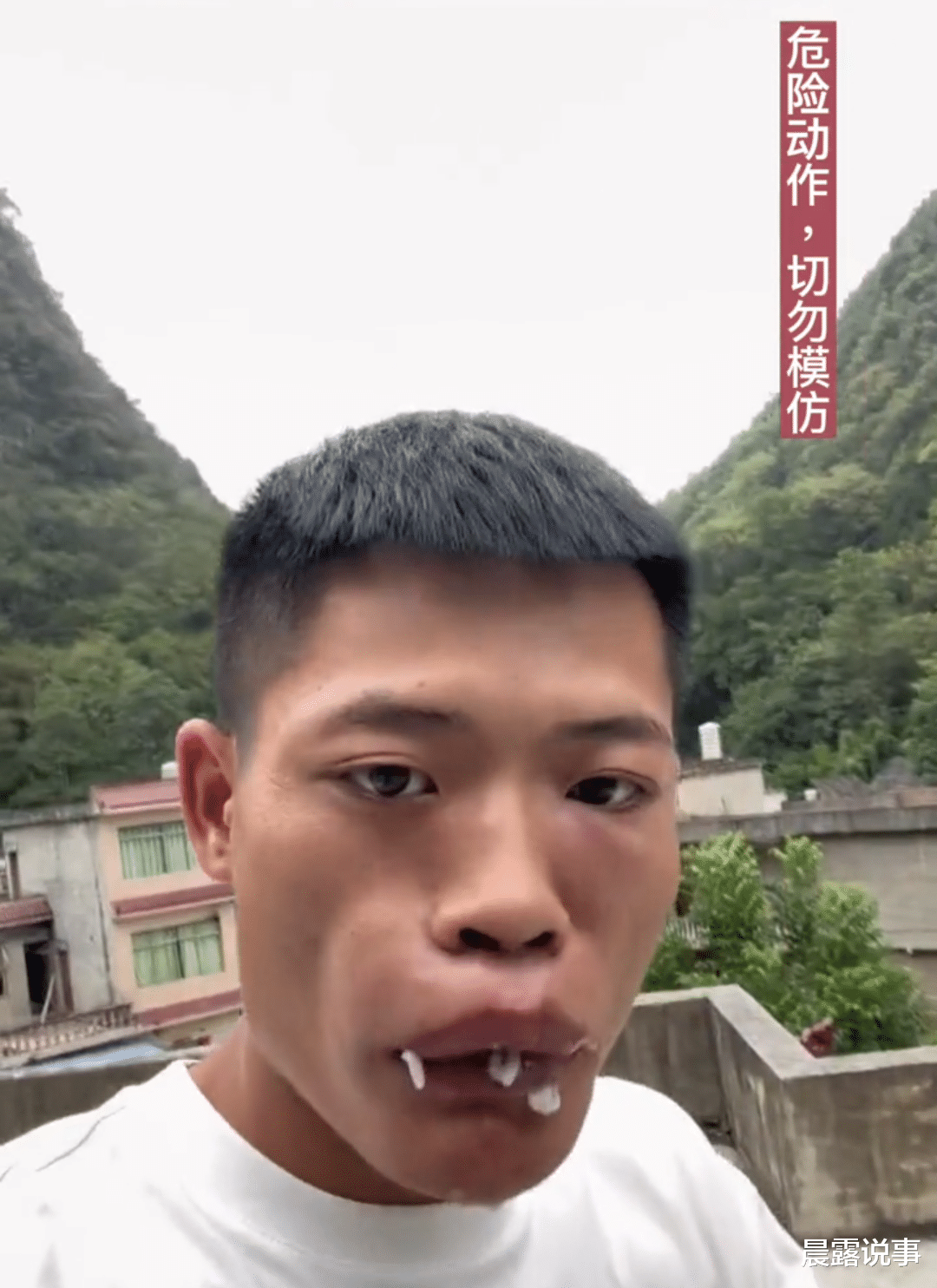 生吃活蜜蜂!贵州男子为博眼球吃蜜蜂后进医院治疗!