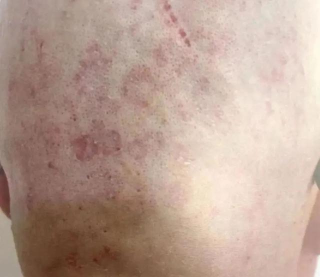 胃炎|警惕！身上的这种小红点是病毒感染，小心越长越多