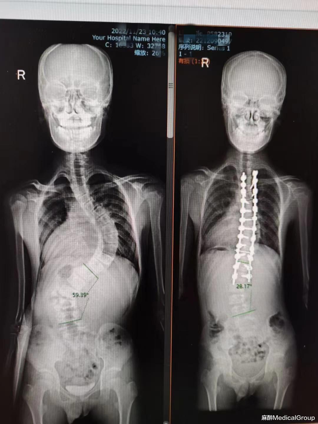 hiv|在脊柱手术围术期血液保护,我们有这些措施可做