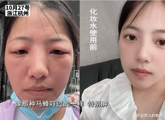 浙江萧山:女子用了一瓶化妆水,皮肤过敏双眼皮变单眼皮,张口索赔就是一万元