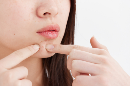 护理|前胸后背长痘该如何护理？牢记这3条是关键