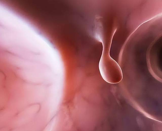 胃病|治好胃息肉,做到这一点就够了。