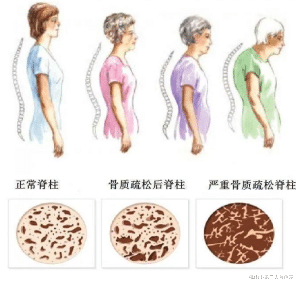 骨质疏松|不想腰背酸疼腿抽筋驼背变矮，多晒太阳多补钙