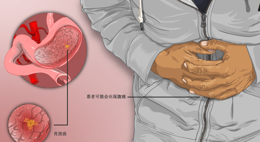 驼背|奥美拉唑创新型口服液体制剂!Konvomep获批用于活动性良性胃溃疡