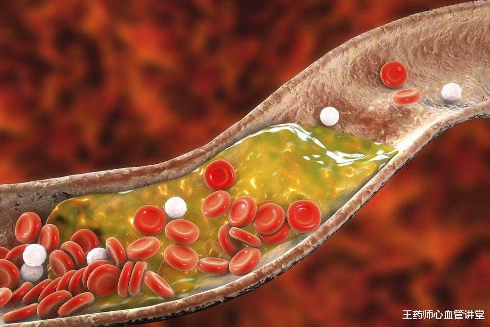 银耳|不稳定斑块比血管狭窄更危险！这些因素会促使其形成，及时避免