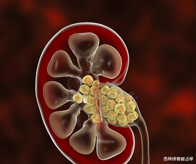 体检|对付结石，一个方子，三条路，一路清热、一路消石、一路止痛