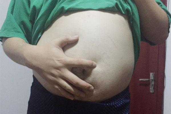 脂肪肝|脂肪肝更“偏爱”这5类人群,占了一个,脂肪肝可能“偷偷拜访”