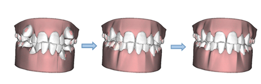 山药|为什么有些人矫正完会反弹?矫正结束要注意哪些问题,牙医告诉你