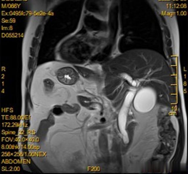 医生|罕见“镜面人”遭遇12指肠肿瘤医生:概率不足百万分之一