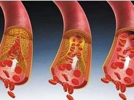 饮食|日本研究发现:血管变“硬”,或许与早饭有关?建议了解下