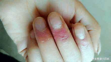 高血压|想知道肝脏好不好？ 伸出“手”来看一看， 别不当回事