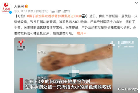被蜘蛛咬一下,会变成蜘蛛侠?医生提醒:不一定,也有可能进ICU