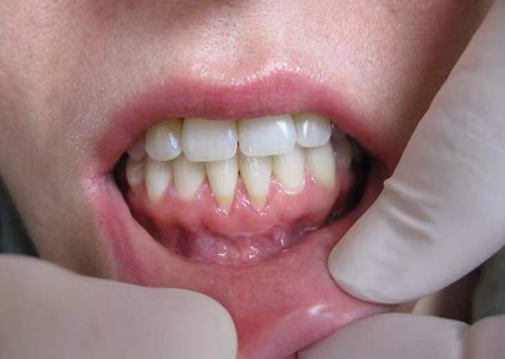牙齿|牙齿为什么松动，还吃饭塞牙？可能肾气不足，中医一个小方法应对！