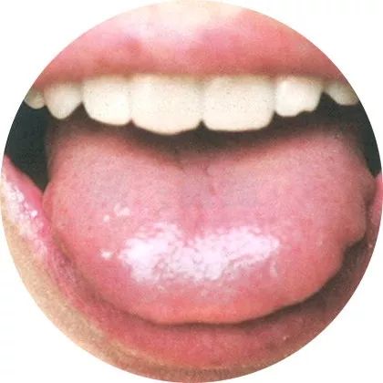 失眠|中医中的舌诊,了解吗