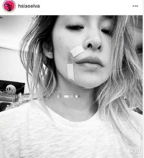 萧亚轩|42岁萧亚轩公开伤情，眼神迷离涣散，右脸明显凹陷触目惊心