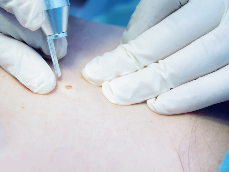 饮食禁忌|皮肤长“小肉球”是怎么回事,可以抠掉吗?如何处理?一文解惑