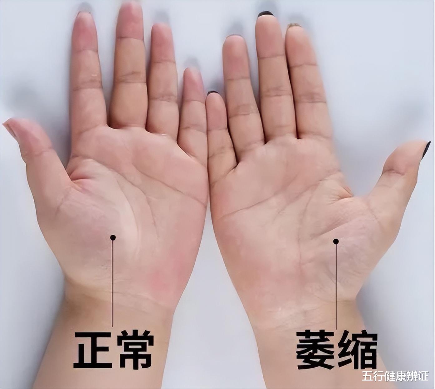 脾胃|手掌中的大鱼际，出现这2种异常，说明体内有寒、痛、赤、热