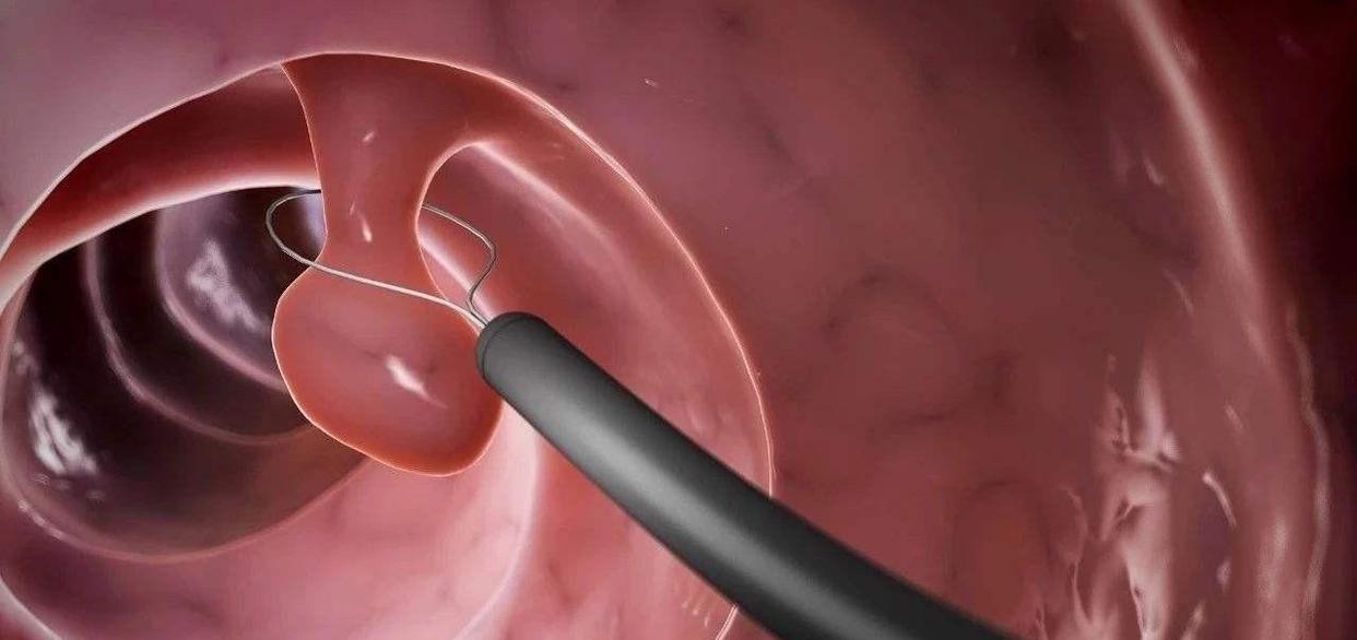 肠息肉|肠道里长了“息肉”，上厕所时早有提示，不要等到中晚期才发现