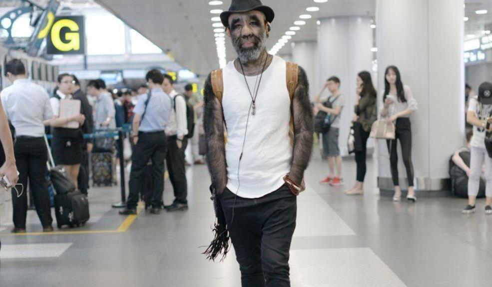 曾惊讶大众的“毛孩”于震寰，44年已经过去，现在他的生活如何？