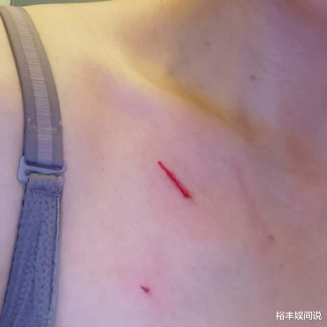 黎淑贤|亚姐黎淑贤遭豹猫袭击！身体多处抓痕血迹斑斑，治疗花费2300元