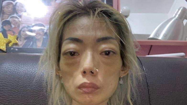 豪门|靠颜值嫁入豪门，被折磨得生不如死，结婚8年瘦到只剩44斤皮包骨