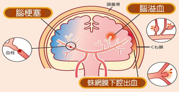 中风|中风多半是拖出来的，牢记7个中风前兆，6大急救措施