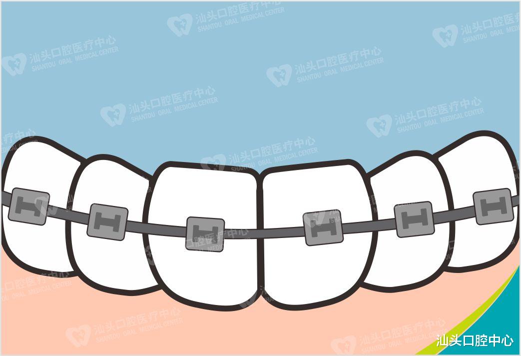 痛经|矫正期间认真刷牙,让牙套之路不再艰险!