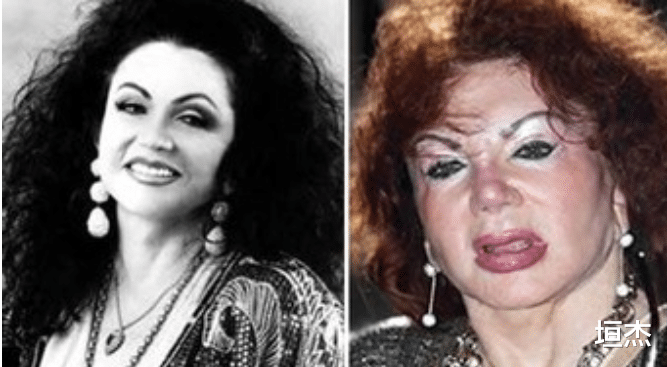 刘晓庆|刘晓庆拉皮多次耳粘脸，郎朗前女友变成锥子精，整容后遗症太可怕