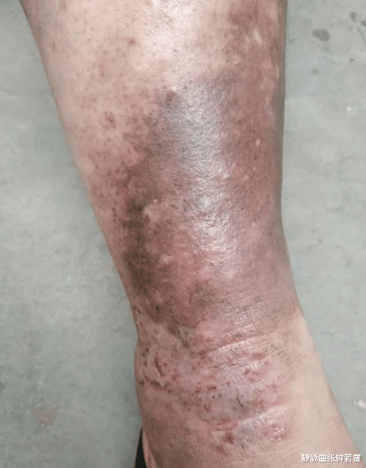 静脉曲张|静脉曲张一直复发？很有可能是这个原因！