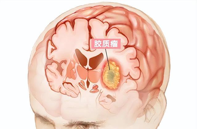 癫痫病|女子头痛怀疑癫痫，直到按摩时闻到臭味，才发现她脑袋长了个瘤