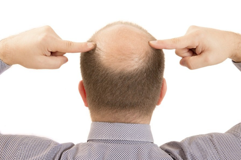 脱发|“米诺地尔”治脱发有副作用？哪些人不能用？不妨收藏以便查看