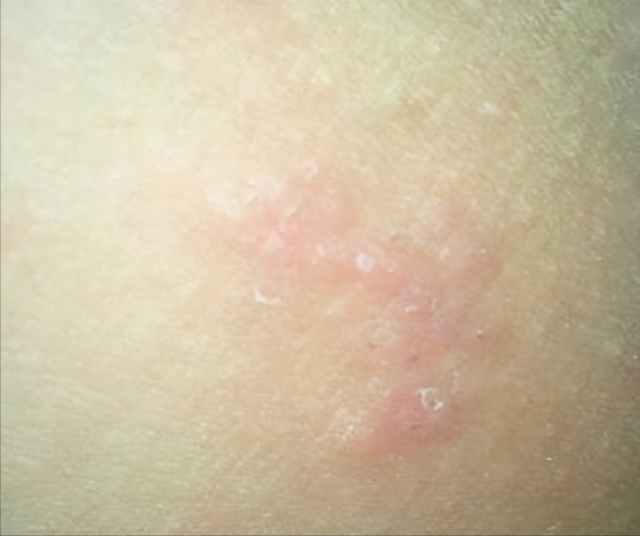 尼古丁|大腿根潮湿，下焦湿热？教你4个中成药，清热除湿，浑身轻松