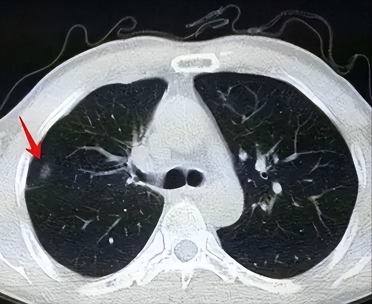 ct检查|肺结节到底切不切?一篇文章全说清楚了