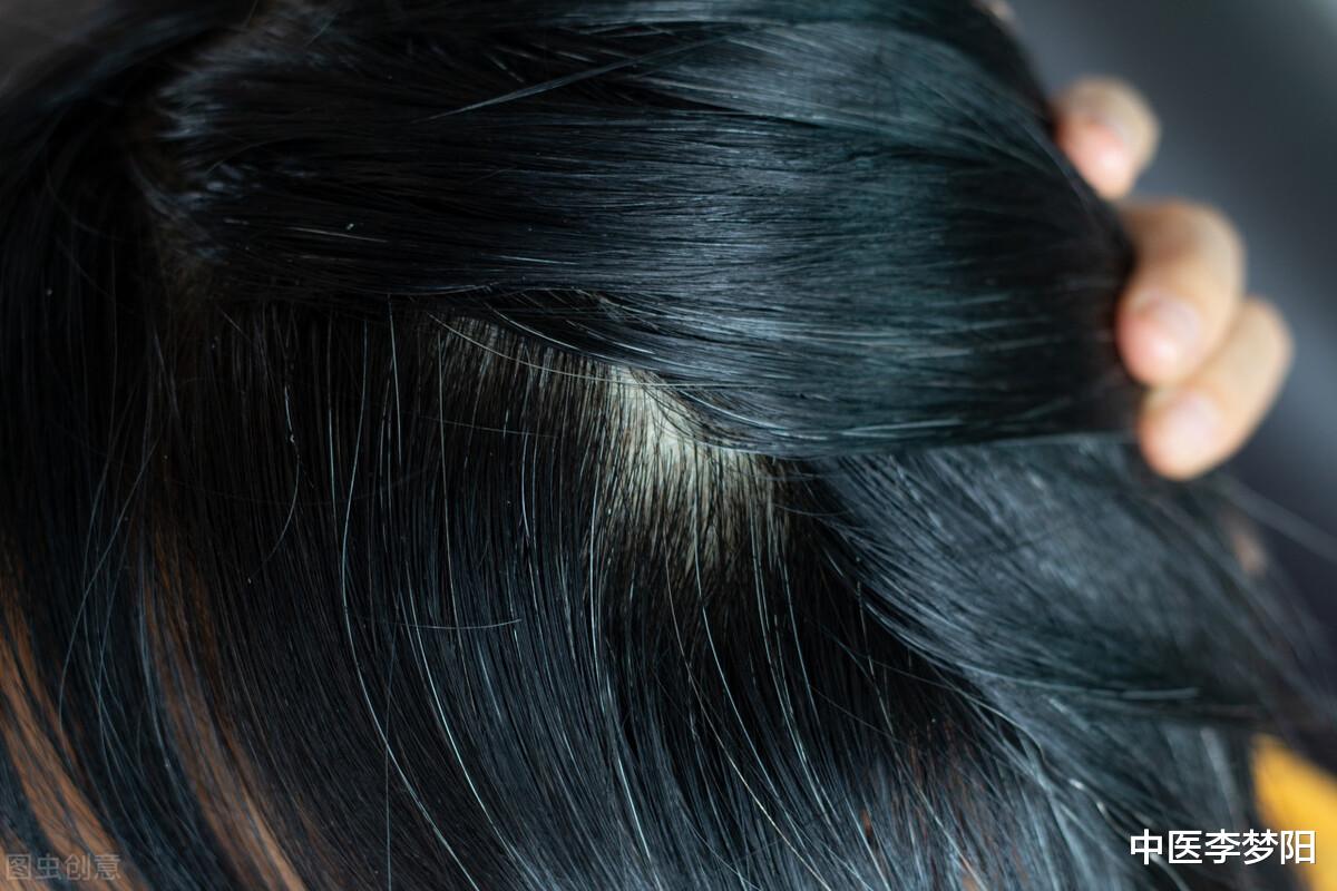 中药|须发早白、脱发谢顶,参考一个中成药,白发黑了,头发也长回来了