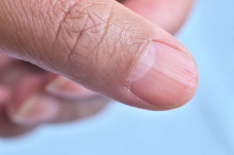 灰指甲|体内有疾，手指先知？指甲出现4种异常，可能是癌或疾病的征兆