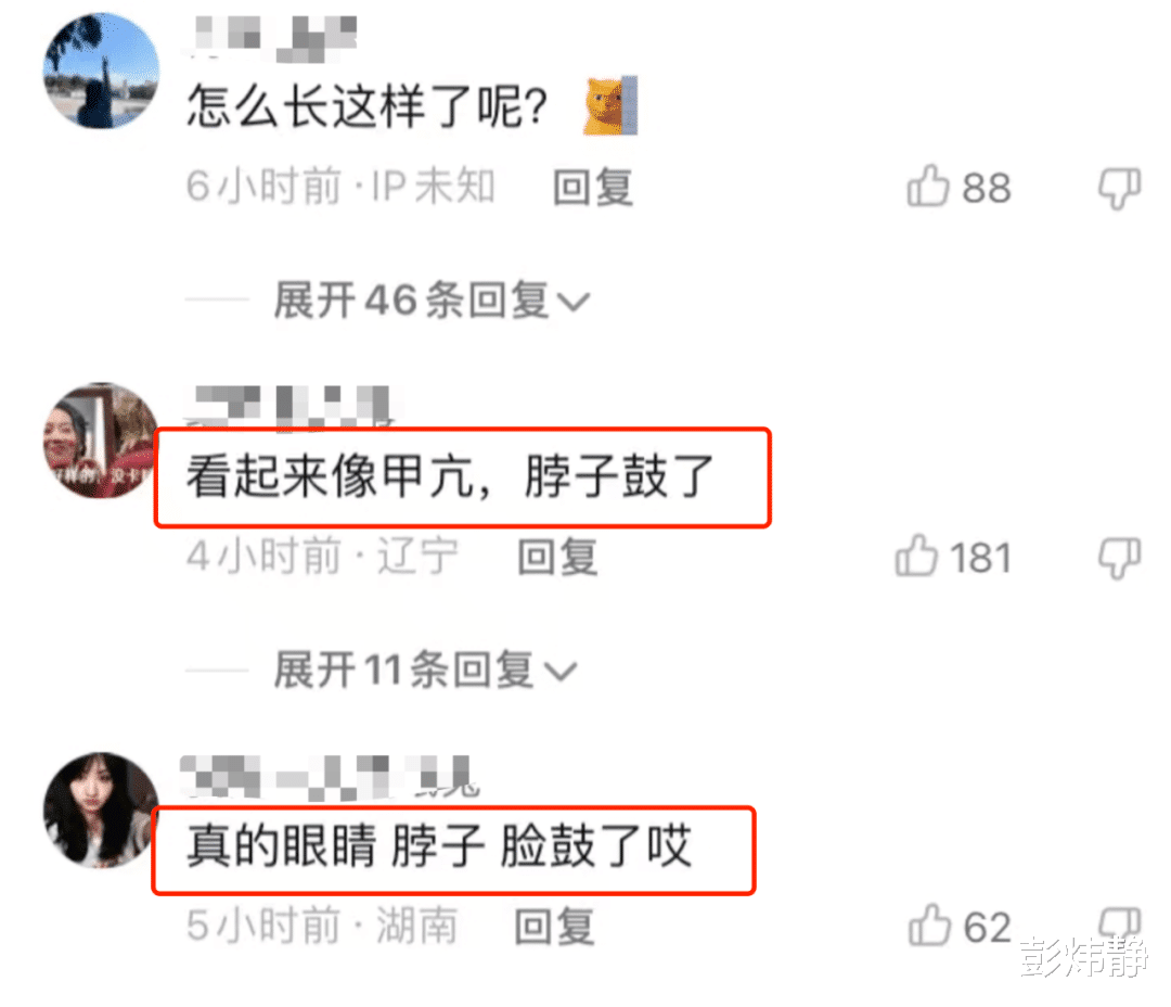 孙俪|孙俪脖子肿大、眼睛凸、腮帮子鼓,网友担心她得甲亢,她仍未回应