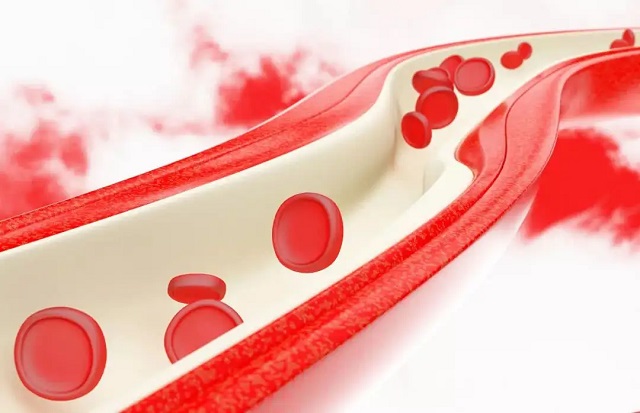 眩晕|胆固醇高了，身体会有四种表现，三个方法降脂，保护血管