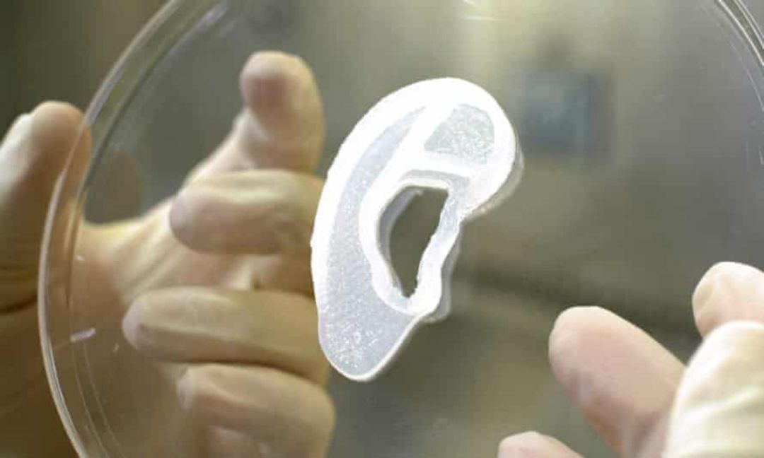 3D打印|世界首例！用患者自身细胞3D打印出新“耳朵”并成功移植