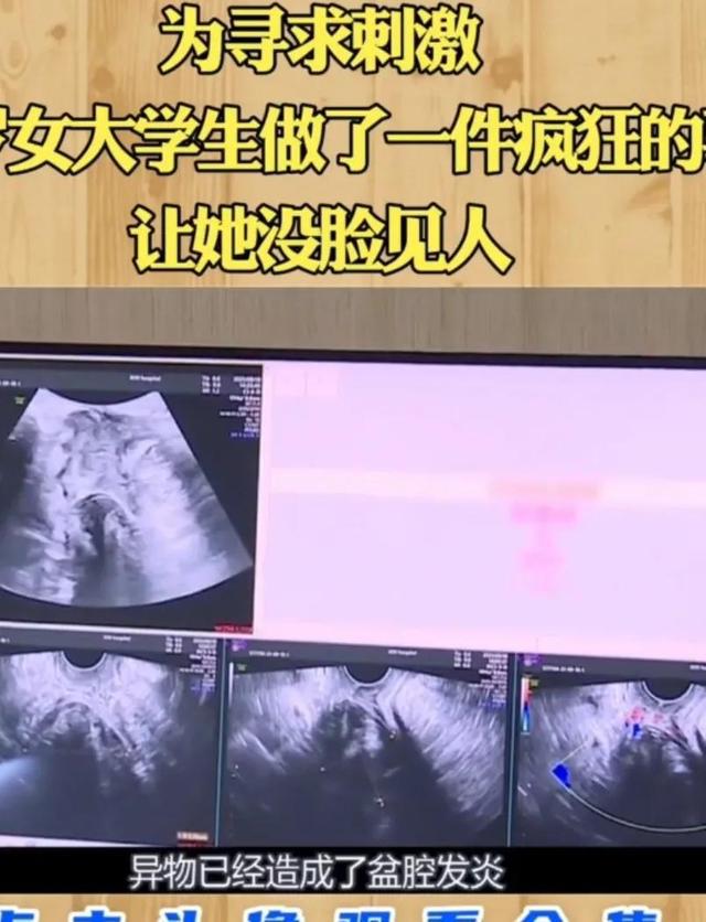 为了寻求刺激,女大学生竟将异物塞进了自己的盆腔里