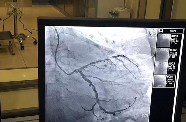 苹果|心脏不舒服：心电图、心脏彩超、心脏造影，哪个检查最准确？