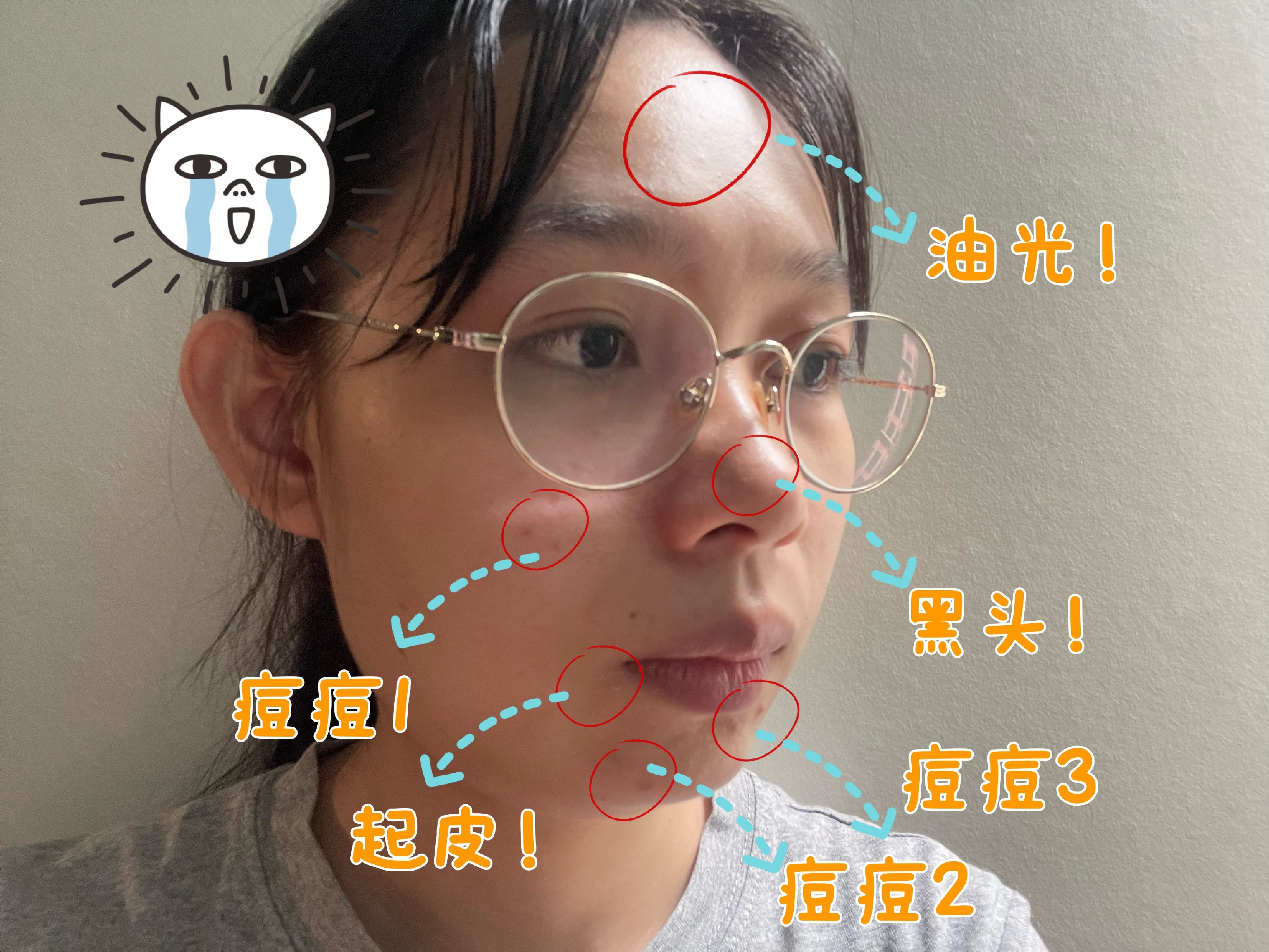 痘痘 皮肤状态不好怎么办？脸部爱出油、黑头、痘痘、起皮，有它就行！
