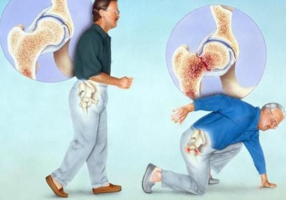 长寿|骨质疏松的“加速器”或被发现，医生：5种食物，平时尽量少吃