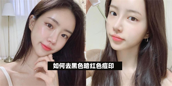护肤 如何去暗红色黑色痘印？护肤达人介绍真正有效去痘印效果好的产品