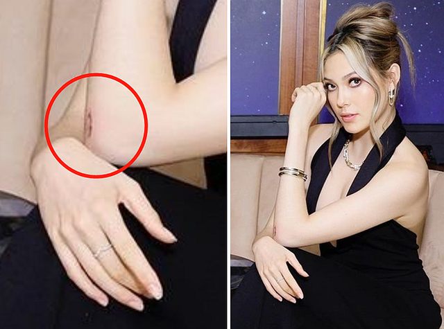 谷爱凌|谷爱凌晒近照令人心疼!手肘伤口疤痕明显,训练时摔得至今未好