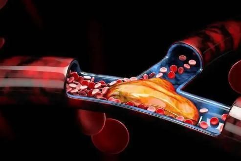 更年期|“血栓大户”被揪出,医生建议管住嘴,别等生病了才着急