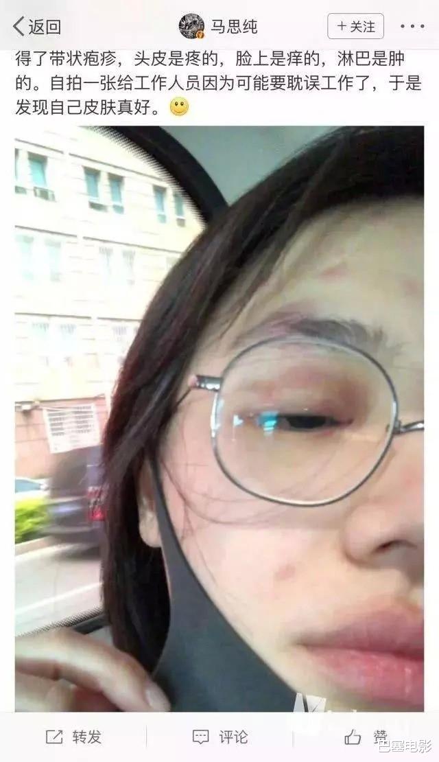 痘痘|浓妆都盖不住，再靓的女星皮肤一差，都这么吓人