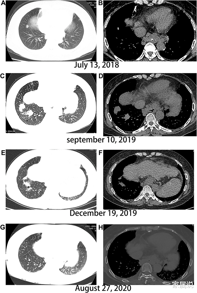 肝癌|转移灶相继消失!索拉非尼耐药后序贯使用瑞戈非尼+信迪利单抗