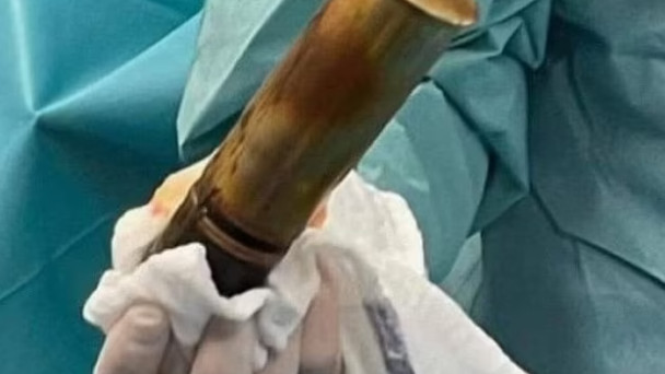 啼笑皆非, 国外男子屁股里插着炮弹走进医院!