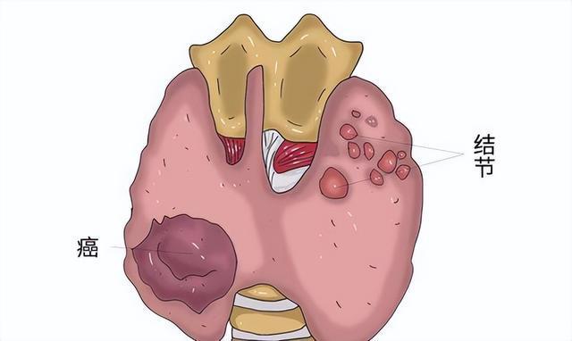 疾病|心情郁闷、两肋胀痛?多半是肝郁!该用逍遥散还是柴胡舒肝散?